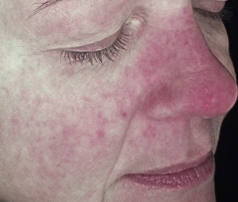 client sensitivity and redness at SKIN lounge Aesthetics Richmond Hill