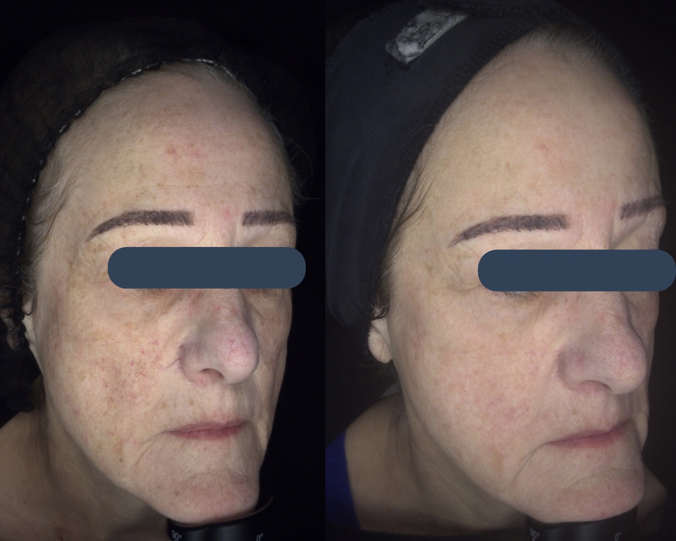 client before and after / testimonial at SKIN lounge Aesthetics Richmond Hill