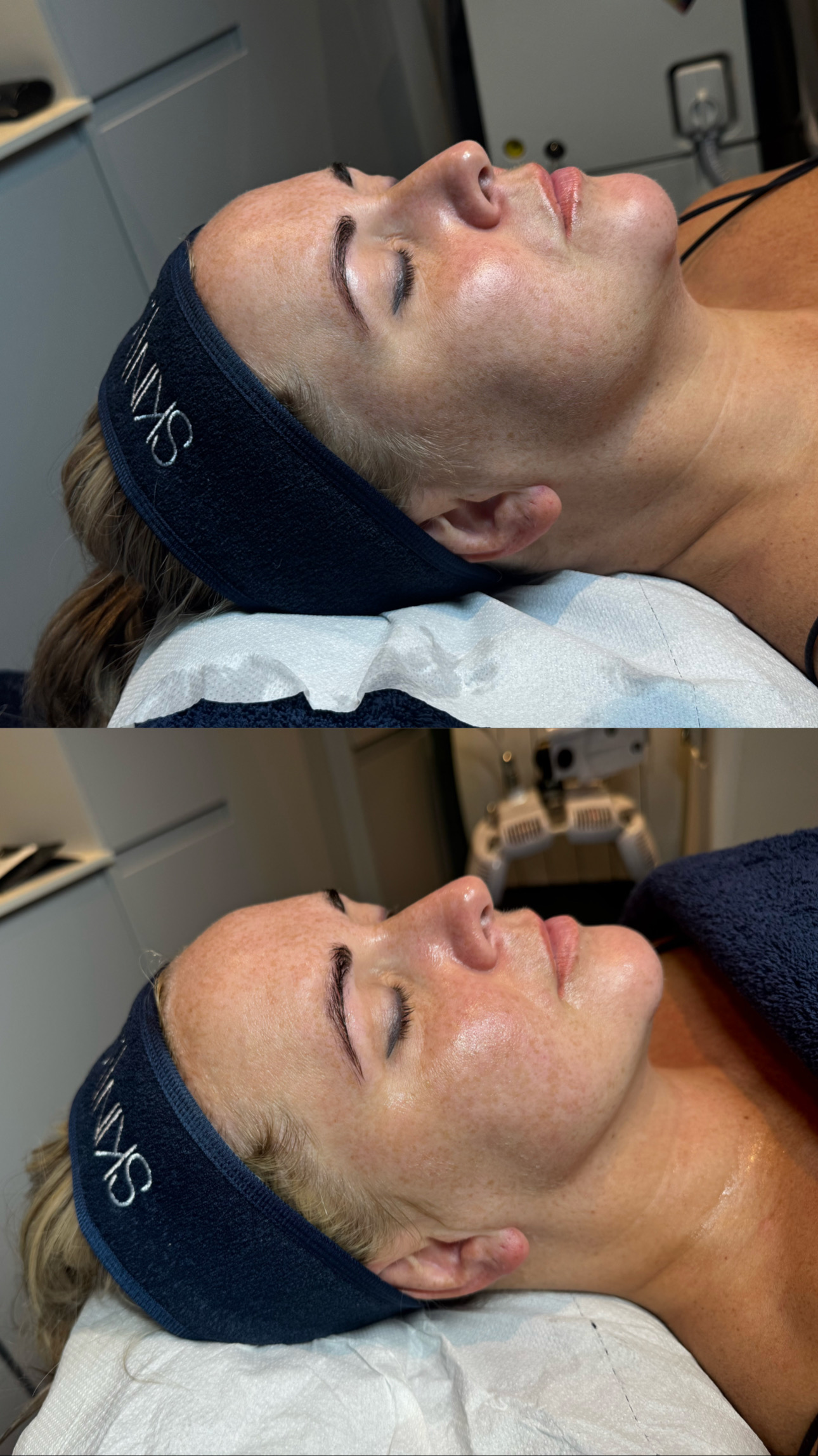 HIFU before & afters at SKIN lounge Aesthetics Richmond London