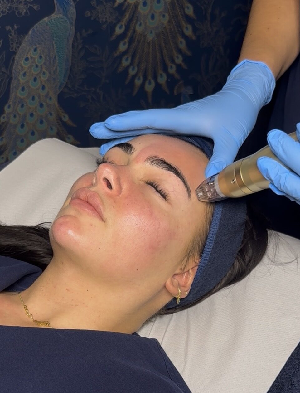 Sylfirm RF Microneedling at SKIN lounge Aesthetics Richmond London