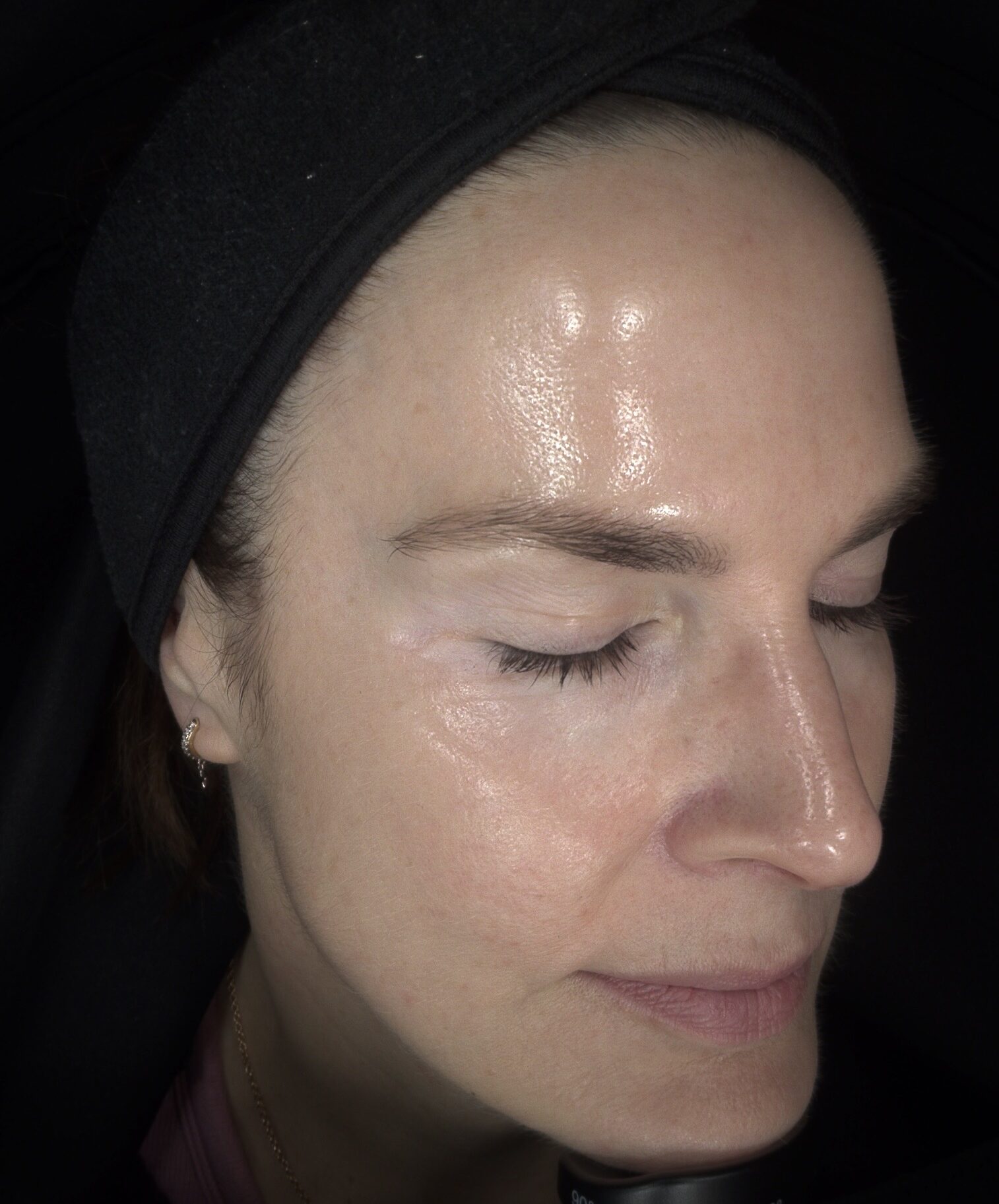 Client glass skin from regular treatments at SKIN lounge Aesthetics Richmond, London beautiful clear, healthy skin after regular treatments at SKIN lounge Aesthetics Richmond London
